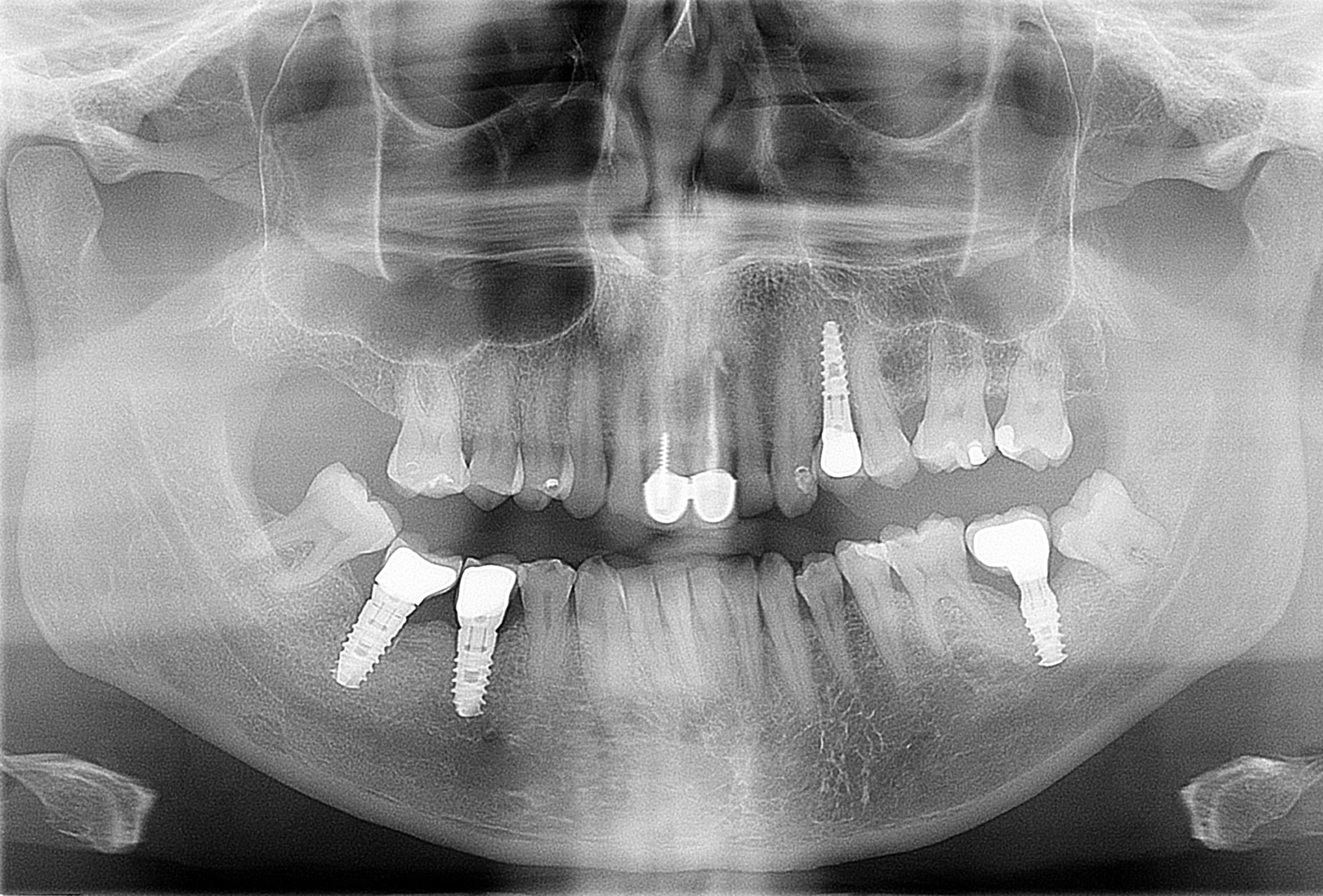 cropped-dental-implants-1-.jpg