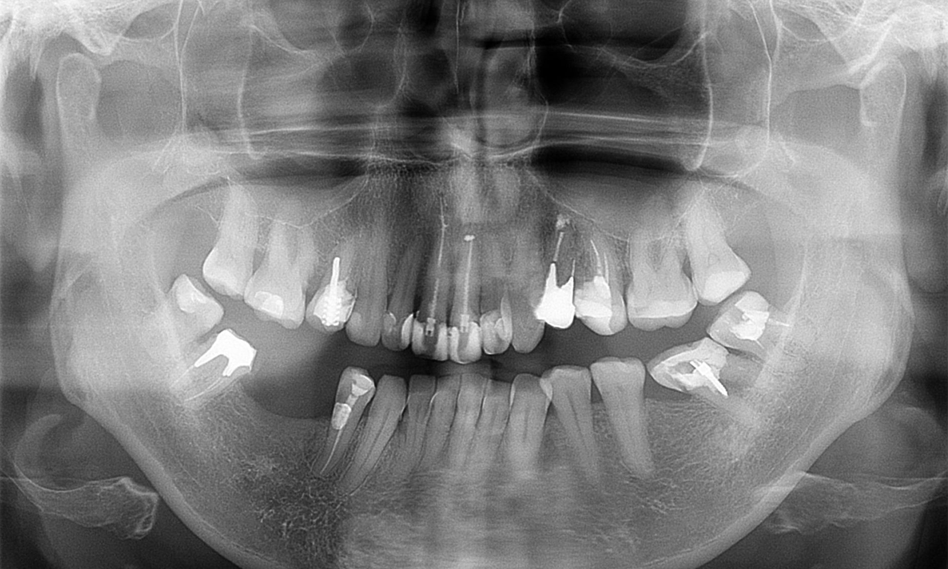 cropped-dental-implants-2.jpg