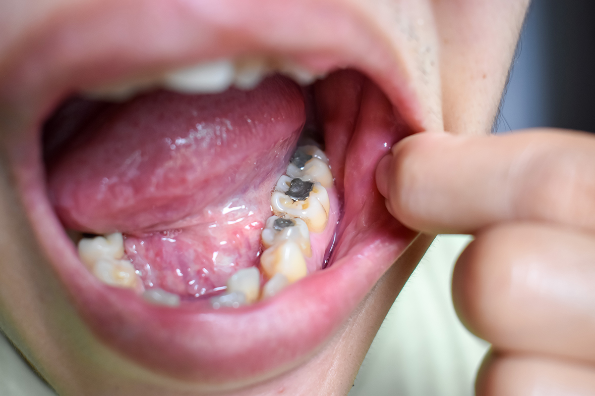 mercury poisoning from fillings